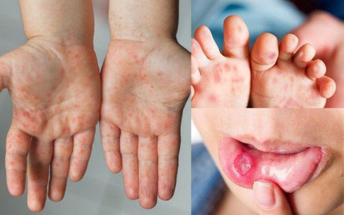 Mắc bệnh tay chân miệng, cần làm gì để phòng biến chứng?