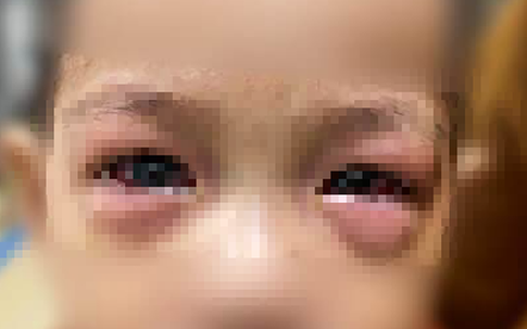 Bác sĩ Bệnh viện Nhi Trung ương khuyến cáo, gần 50 ca đau mắt đỏ trong một tháng, khoảng 20% có biến chứng nặng