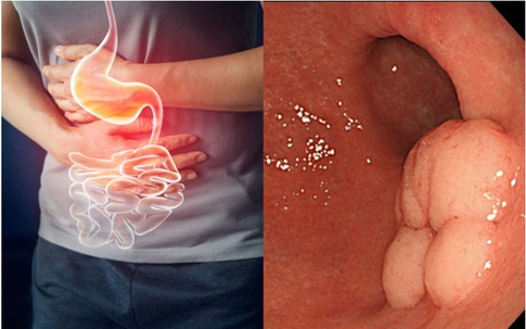 Bác sĩ bệnh viện K chỉ cách phòng ngừa ung thư dạ dày hiệu quả