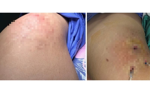 Người phụ nữ 31 tuổi bị áp xe mông sau tiêm filler làm đẹp ở spa