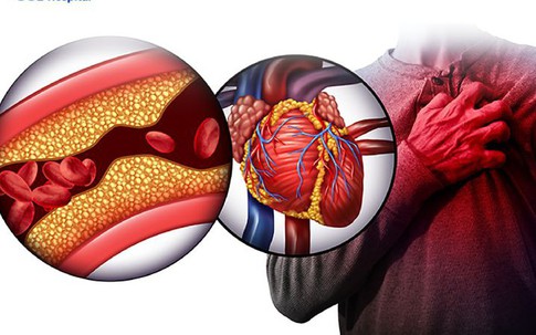 Bệnh mỡ máu cao tàn phá cơ thể như thế nào? Đây là cách phòng ngừa bệnh hiệu quả