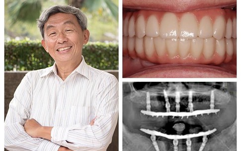 Trồng răng Implant từ tính an toàn cho mọi đối tượng