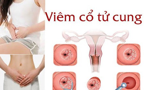 4 cách phòng bệnh vùng kín hiệu quả, đây là 3 thực phẩm chị em cần tránh để bảo vệ tử cung 