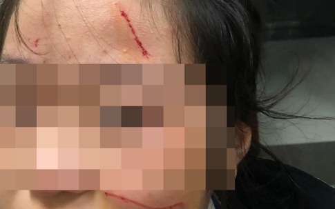 Thực hư thông tin nữ sinh Hà Nội bị rạch mặt tại trường học