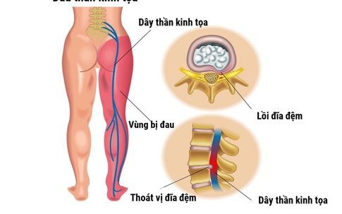 Đau thần kinh tọa - Nguyên nhân và cách hỗ trợ cải thiện