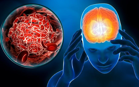 Thanh niên 26 tuổi đột quỵ ngay trên bàn làm việc, thừa nhận có thói quen nhiều bạn trẻ Việt mắc phải