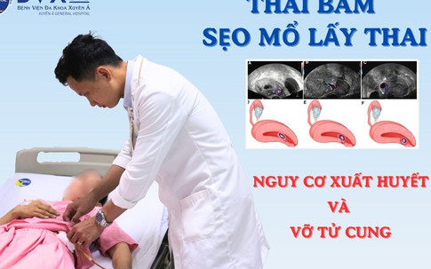 Sản phụ 40 tuổi ở Củ Chi nhập viện gấp vì thai bám ở sẹo mổ nguy hiểm