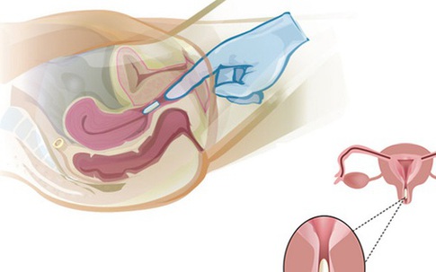 Biện pháp điều trị nấm Candida âm đạo