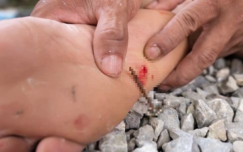 Người đàn ông nguy kịch vì vết xước ngoài da, cảnh báo mối nguy hiểm từ những vết thương dù là rất nhỏ