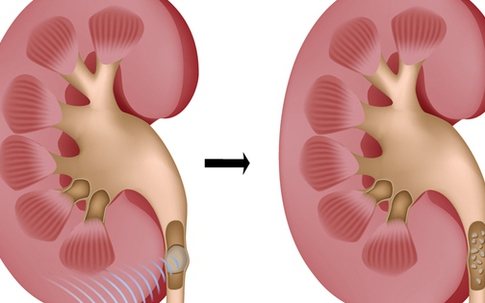 8 câu hỏi thường gặp của người bệnh sỏi tiết niệu