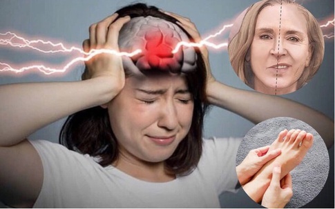 Người phụ nữ 62 tuổi ở Phú Thọ đang khỏe mạnh, bất ngờ bị nhồi máu não sau dấu hiệu phổ biến này