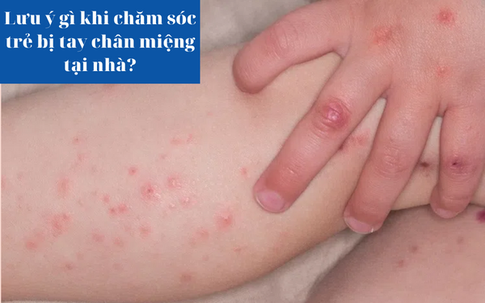Lưu ý gì khi chăm sóc trẻ bị tay chân miệng tại nhà?