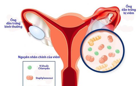 Bé 14 tuổi ở Hà Nội bất ngờ nhập viện vì viêm phần phụ cấp, bác sĩ cảnh báo nguyên nhân