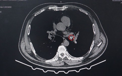 Người đàn ông 52 tuổi ở Quảng Ninh bất ngờ với thứ được gắp ra từ phế quản sau khi ho cả tháng