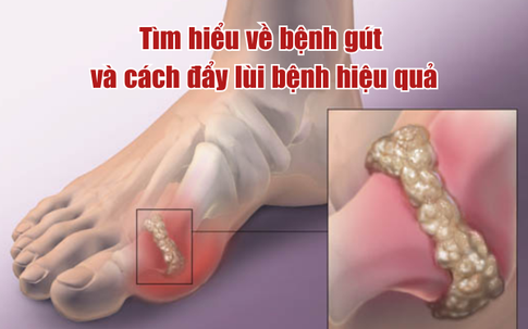 Tìm hiểu về bệnh gút và cách hỗ trợ kiểm soát bệnh