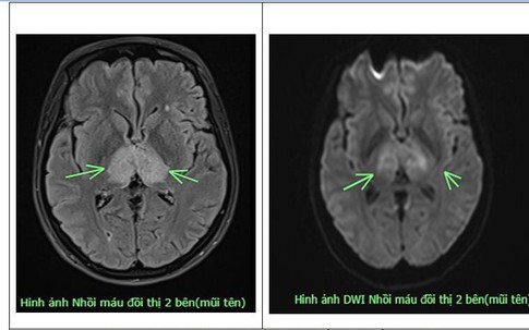 Đau đầu 4 ngày uống thuốc không đỡ, người phụ nữ 38 tuổi mắc bệnh nguy hiểm ở não