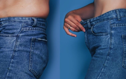 Phẫu thuật ‘nắn’ xương sườn giúp cô gái gen Z có vòng eo con kiến, giảm 15cm