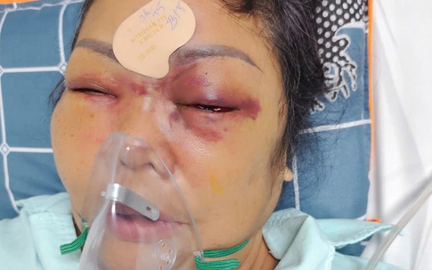 Nâng mũi cải vận nhận lại nỗi đau (bài 2): Nhân vật bảo 'có', chủ cơ sở thẩm mỹ nói 'không liên quan'