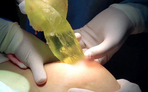 Người phụ nữ bị rò rỉ, vỡ túi ngực sau 14 năm nâng ngực: Túi ngực có thời hạn được bao lâu?