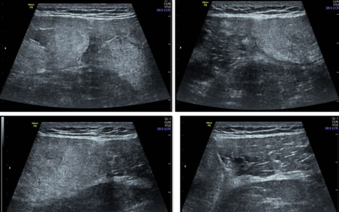 Nam thanh niên nhập viện gấp vì tiêu cơ vân cấp do tập gym kéo dài 2 giờ/lần tập