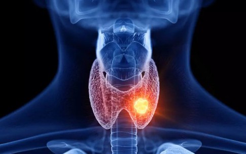 U nang tuyến giáp khi nào cần phẫu thuật? Cảnh giác với dấu hiệu u tuyến giáp ác tính