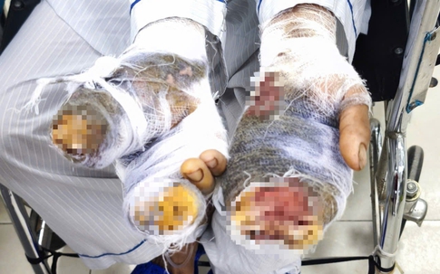 Người phụ nữ Hưng Yên bị chó nhà nuôi tấn công khi đang cho ăn