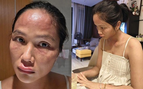 Hoa hậu H'Hen Niê bất ngờ chia sẻ mặt sưng nề, mẩn đỏ sau sinh con, căn bệnh cô mắc nguy hiểm thế nào?