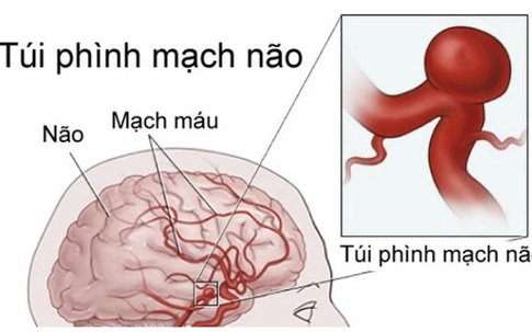 Người phụ nữ đi khám vì đau đầu bất ngờ phát hiện phình mạch máu não nguy hiểm