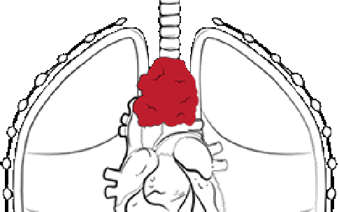 U trung thất và những lựa chọn phẫu thuật