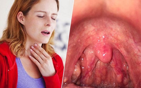 Cách phòng ngừa bệnh viêm họng cấp lúc giao mùa đơn giản mà hiệu quả nhất