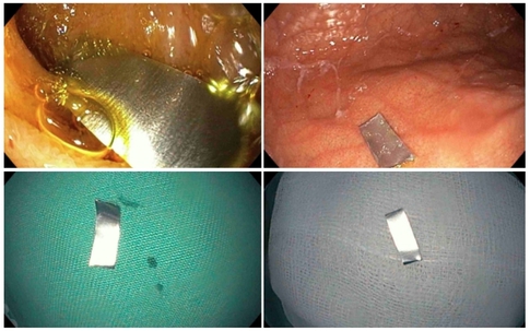 Bé 10 tháng suýt thủng ruột vì nuốt 'lưỡi dao' trong điếu thuốc lá