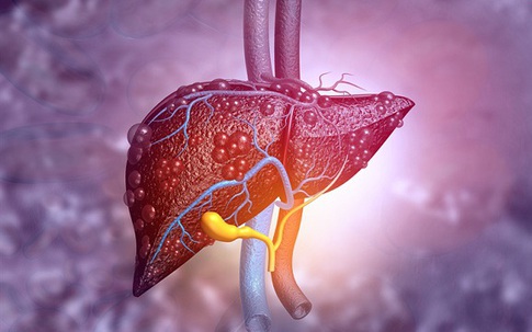 Người đàn ông 49 tuổi may mắn phát hiện bệnh lý gan nguy hiểm nhờ 1 việc mà rất nhiều người Việt bỏ qua