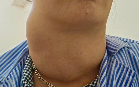 Dấu hiệu cảnh báo bệnh tuyến giáp cần khám ngay, tuyệt đối không chủ quan