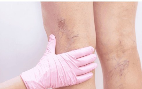 Bí quyết bảo vệ đôi chân khỏi suy tĩnh mạch chi dưới