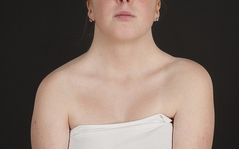 Hy Hữu: Thai phụ 27 tuổi phát hiện bệnh lý hiếm gặp trong lần làm xét nghiệm không xâm lấn (NIPT)