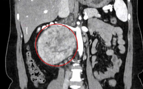 Nhầm lẫn đau lưng do tập thể thao, người phụ nữ đi khám phát hiện khối u 'khổng lồ'