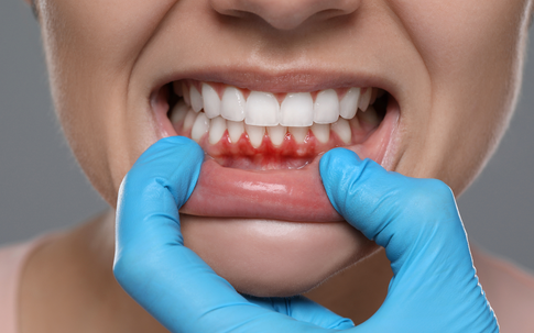 Nướu răng khỏe mạnh không khó: 1 thay đổi nhỏ trong bữa ăn, hiệu quả bất ngờ