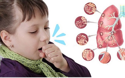 Ho kéo dài không khỏi, bé 20 tháng đi khám phát hiện viêm phổi không điển hình