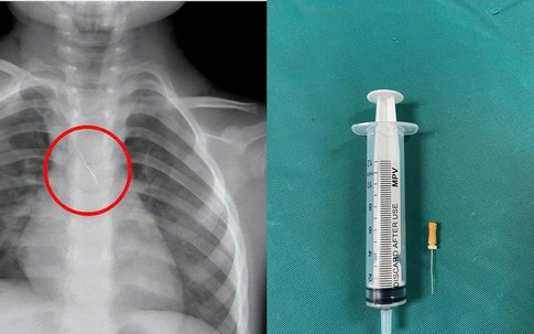 Bé 3 tuổi ở Quảng Trị bị kim chọc tủy kẹt trong đường thở