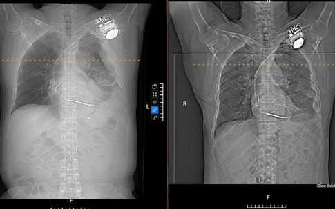 Đi khám vì đau ngực, người đàn ông 58 tuổi bất ngờ phát hiện tràn dịch màng phổi