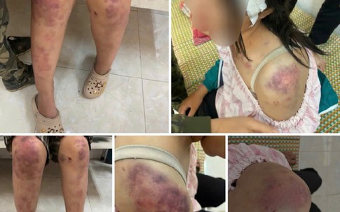 Nghi vấn bé gái lớp 8 ở Thái Nguyên bị người nhà hành hung