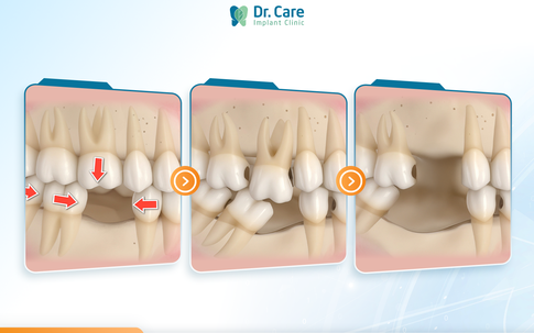 Có nên trồng răng số 6 (răng cấm) khi mất răng, chi phí có đáng với chất lượng?