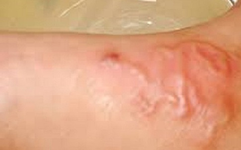 Nhiều trường hợp ở Khánh Hòa bị sán chó, người dân chủ động phòng bệnh