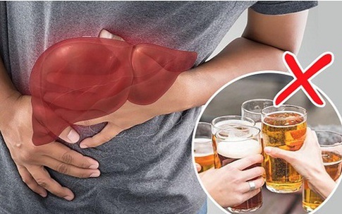 Người đàn ông 45 tuổi men gan tăng gấp 105 lần, suy gan cấp thừa nhận 1 sai lầm nhiều người Việt mắc phải