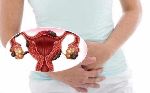 Lạc nội mạc tử cung: Chị em nên biết để phòng bệnh
