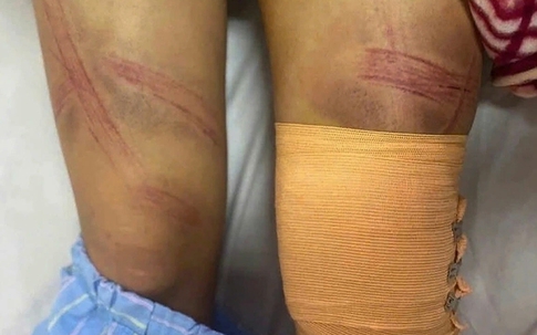 Bé gái 12 tuổi bị bố đánh nhập viện