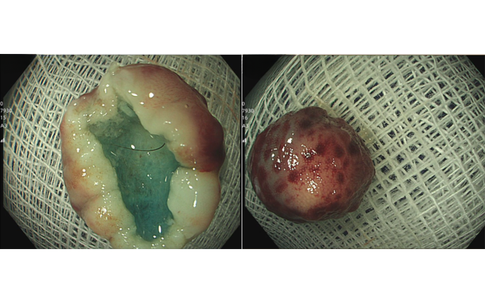 Người phụ nữ 32 tuổi bất ngờ phát hiện u thần kinh nội tiết từ một việc nhiều người Việt bỏ qua