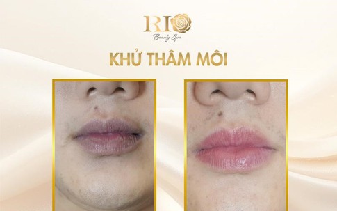 Hết thâm môi nhanh nhờ công nghệ khử thâm môi mới