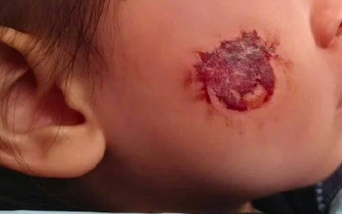 Bé gái 3 tuổi bị bỏng rộp cả mặt vì 'miếng dán đồ chơi': Nhiều đồ chơi hot trên mạng tuyệt đối không mua