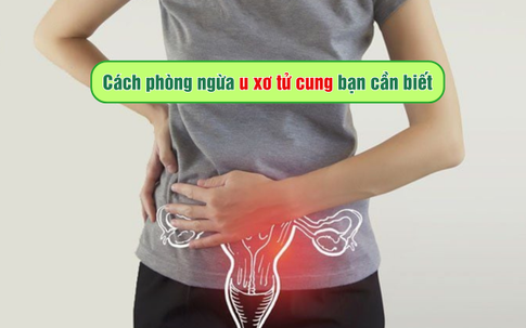 Cách phòng ngừa u xơ tử cung bạn cần biết